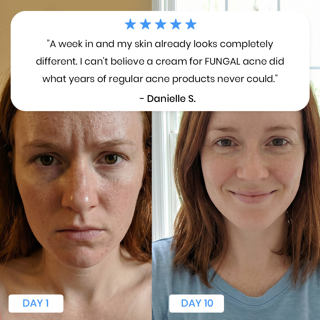 New Aura™ Anti-Fungal Acne Cream